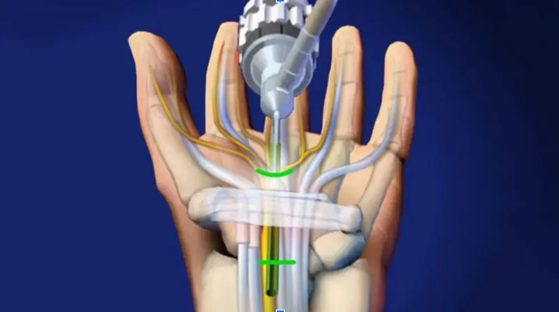  Hand Wrist and Upper Limb Surgery in Hyderabad
